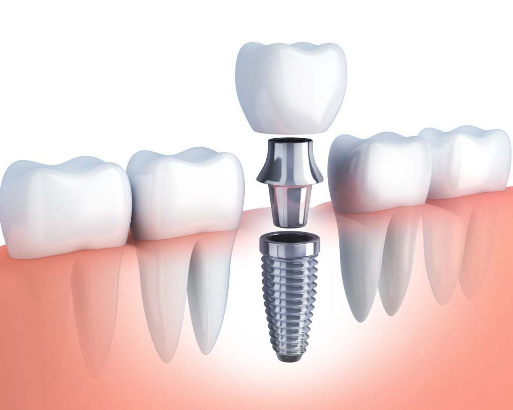 Top 6 Benefits of Dental Implants