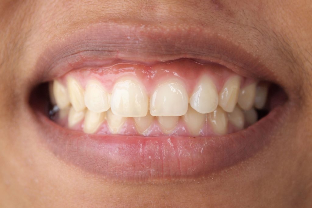 Have Uneven Gum Lines? These May Be The Reasons!
