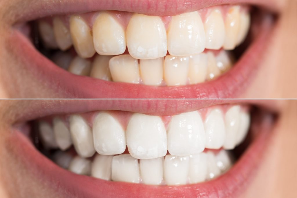 The Science Behind Teeth Whitening: How It Works and What to Expect?