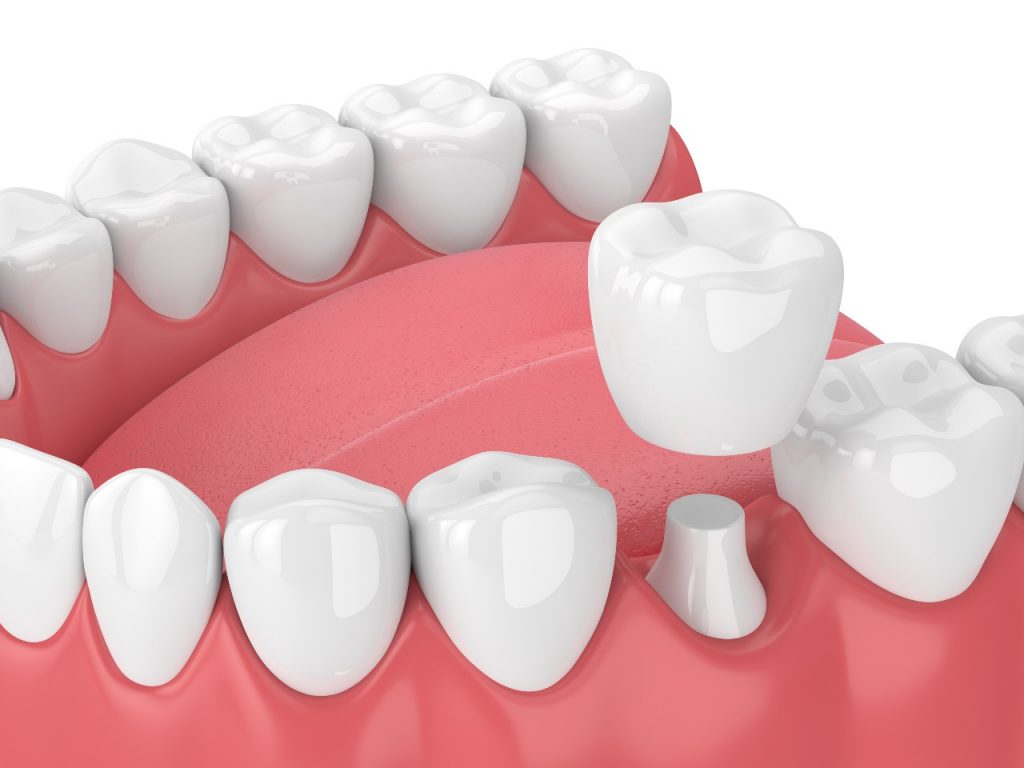 Dental Crowns: Pros and Cons