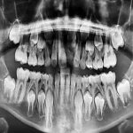 The Importance Of Dental X Rays In General Dentistry